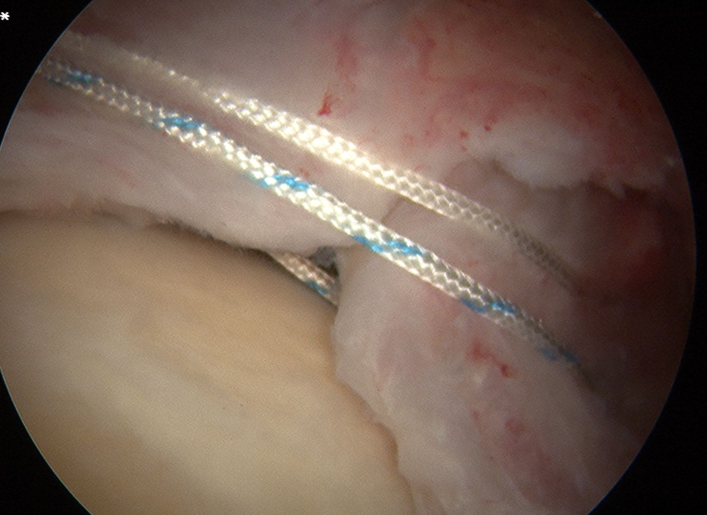 Arthroscopic Cuff Repair Margin Convergance 1